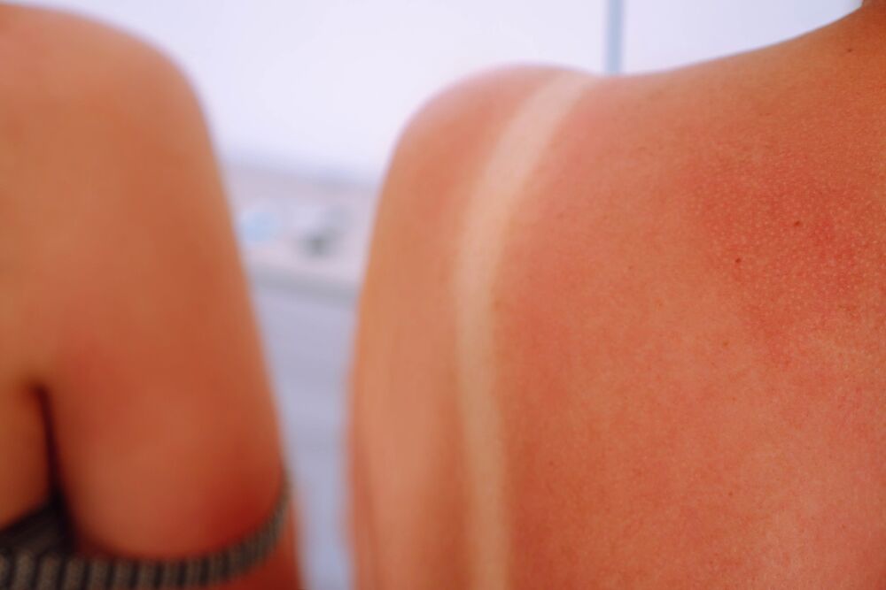 Opekotina, Sunce, Sunčanje