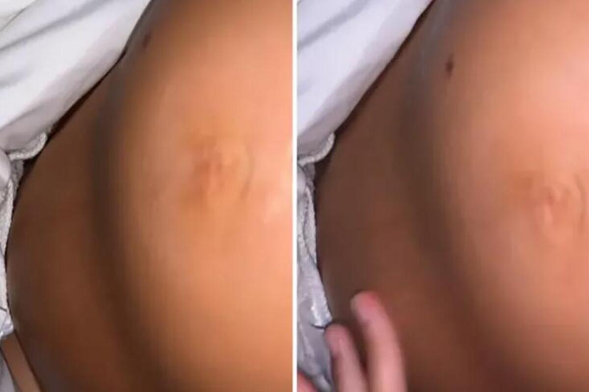 Trudnički stomak joj se prepolovio na dva dela jer se beba okrenula