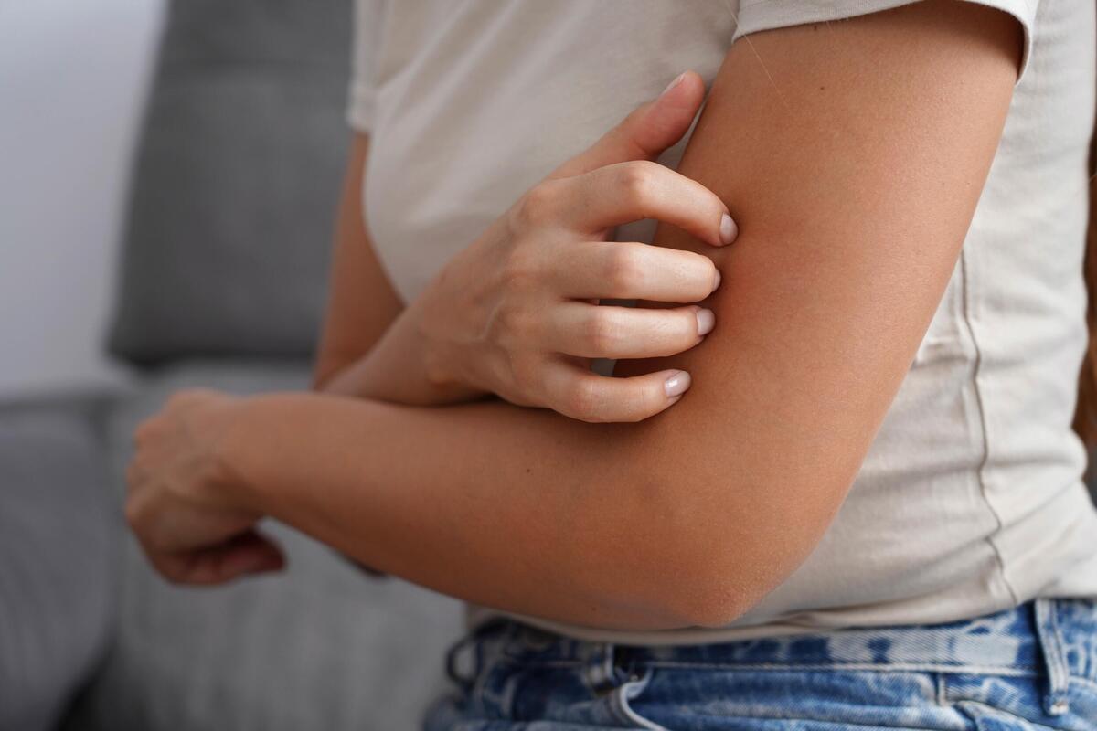Atopijski dermatitis pogađa sve više dece u Srbiji